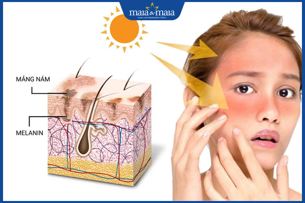 Nám da có di truyền không? Cách ngừa nám da hiệu quả 3 nguyên tắc điều trị nám