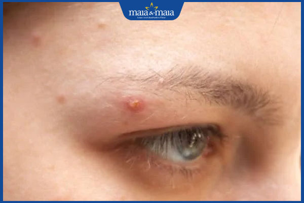 Hướng dẫn nhổ lông mày bằng nhíp tại nhà hiệu quả tối ưu 2 nhổ lông mày bị nổi mụn