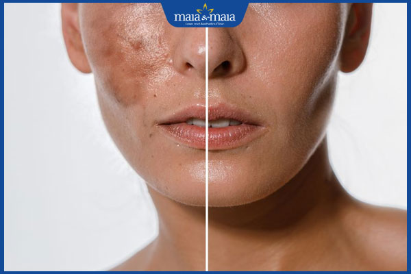 Peel da trị nám an toàn, phục hồi da sáng mịn chuyên sâu 2 peel da bong sừng