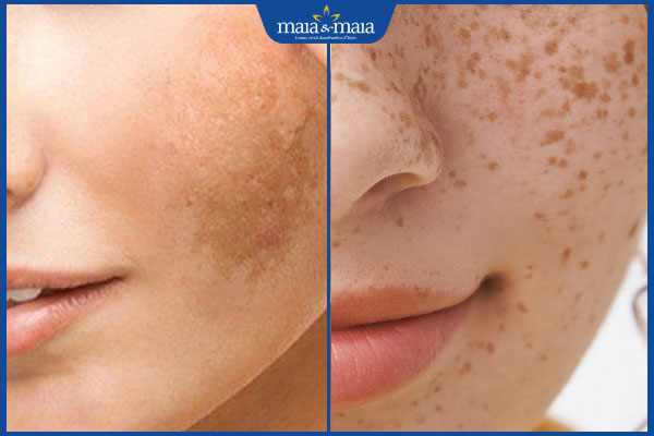 sự khác nhau giữa nám da với tăng sắc tố