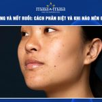 tàn nhang và nốt ruồi