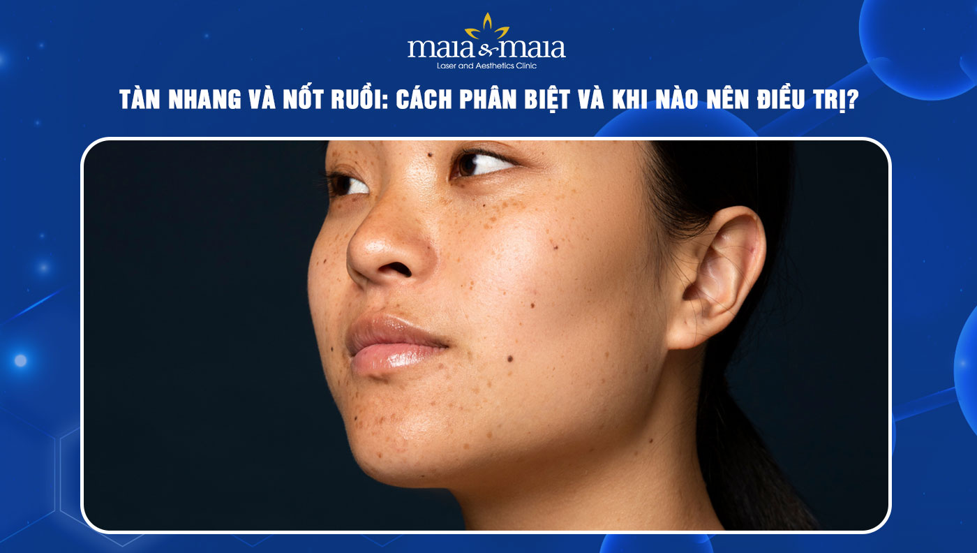 tàn nhang và nốt ruồi