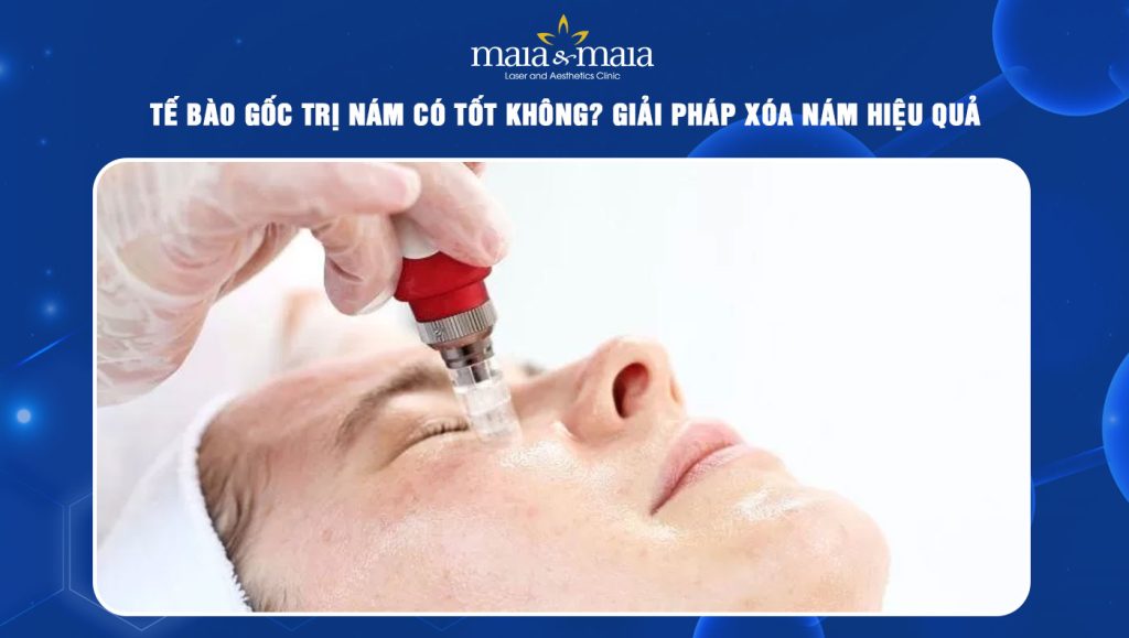 tế bào gốc trị nám