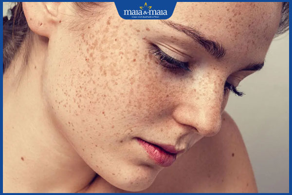 thăm khám khi nám đậm màu