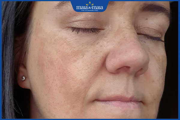 tình trạng da nám nhẹ