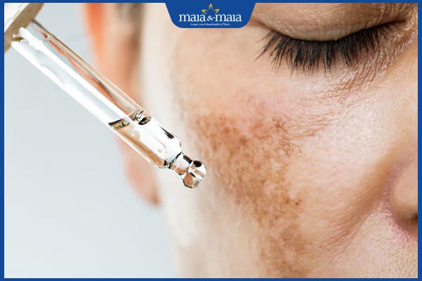 tranexamic acid trị nám