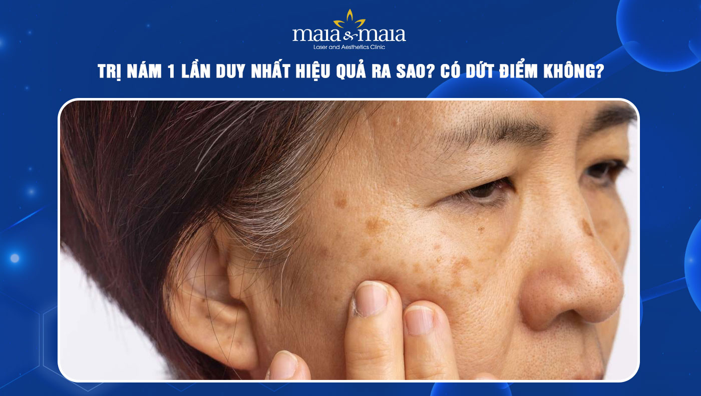 trị nám 1 lần duy nhất