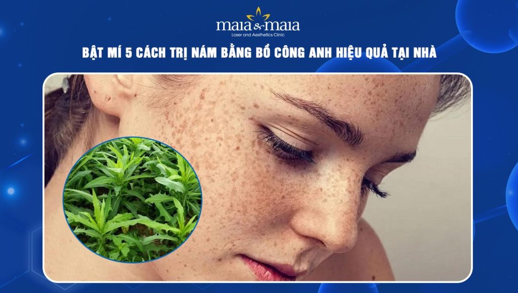 trị nám bằng bồ công anh