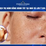 trị nám bằng hành tây
