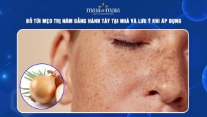 trị nám bằng hành tây