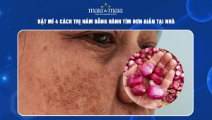 Bật mí 4 cách trị nám bằng hành tím đơn giản tại nhà 96 trí nám bằng hành tím