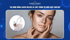 Trị nám bằng Laser Helios III: Quy trình và hiệu quả làm đẹp 61 trị nám bằng laser helios iii