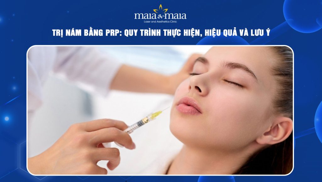 Trị nám bằng PRP: Quy trình thực hiện, hiệu quả và lưu ý  1 trị nám bằng prp