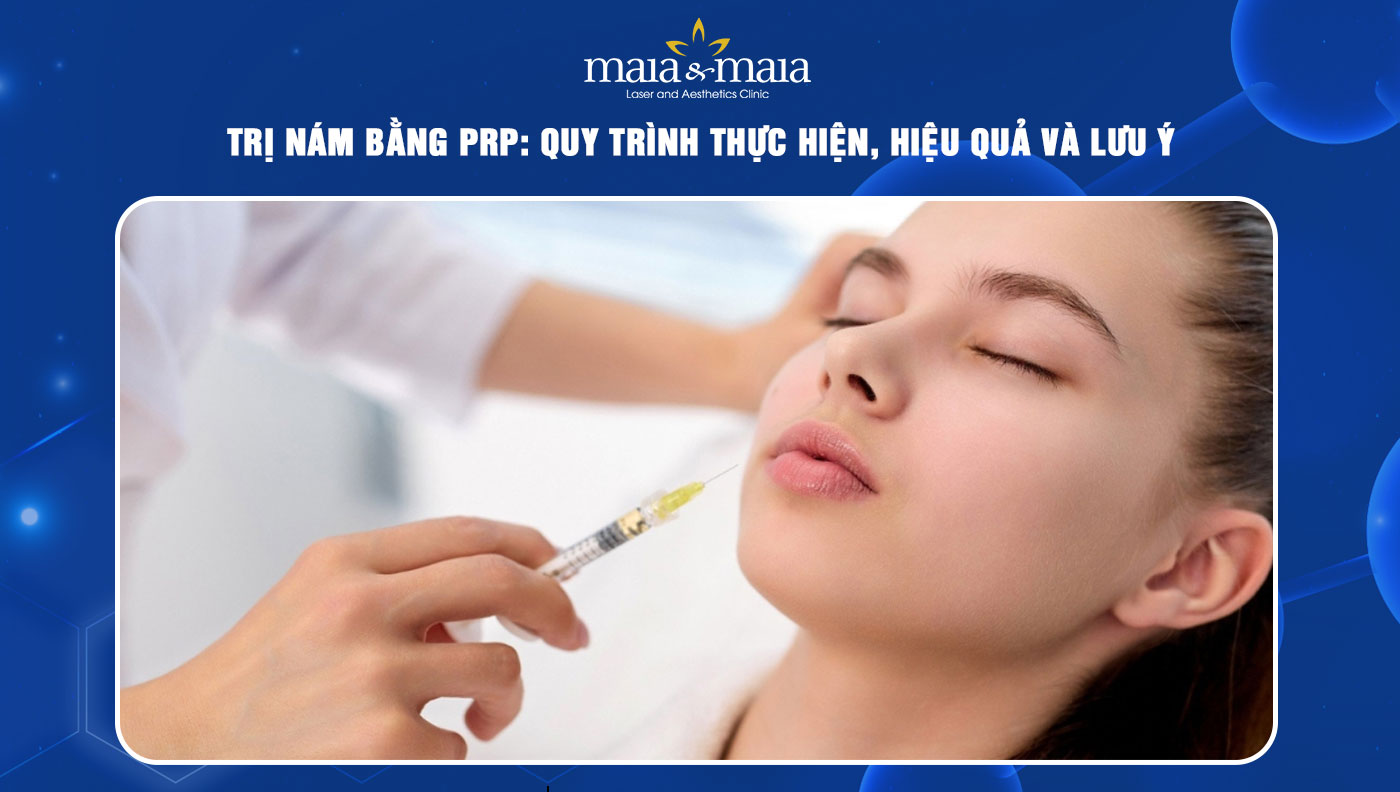 Trị nám bằng PRP: Quy trình thực hiện, hiệu quả và lưu ý  13 trị nám bằng prp