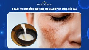 5 cách trị nám bằng rượu gạo tại nhà giúp da sáng mịn, đều màu 44 trị nám bằng rượu gạo