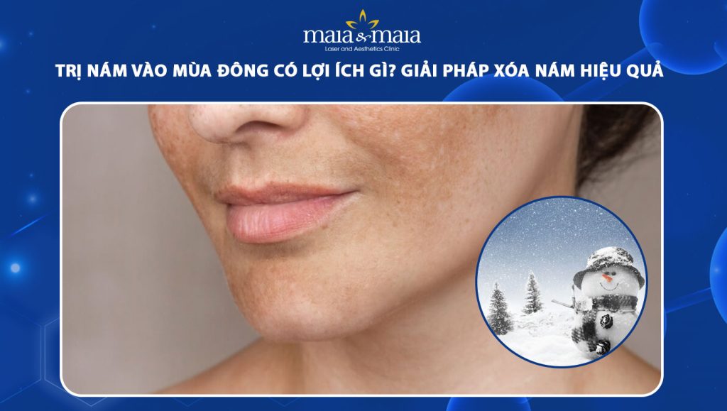 Trị nám vào mùa đông có lợi ích gì? Giải pháp xóa nám hiệu quả 1 trị nám vào mùa đông