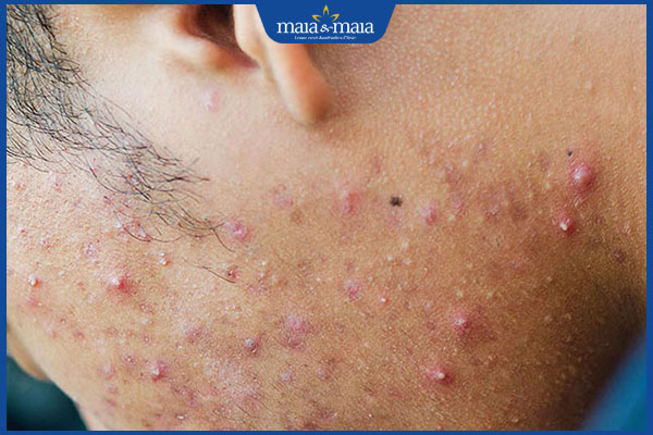 Cạo râu bị viêm nang lông: Biểu hiện và cách xử lý hiệu quả 2 viêm nang lông sau cạo râu