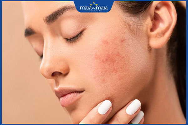 bề mặt da sần đỏ