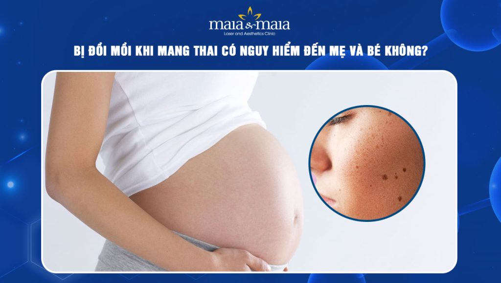 bị đồi mồi khi mang thai