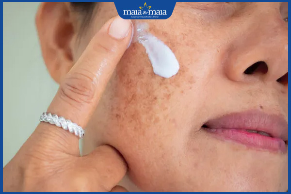 bôi kem xóa đồi mồi