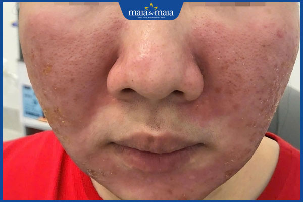 Chấm tàn nhang có hiệu quả không? Giải pháp thay thế ưu việt 3 bỏng da mặt