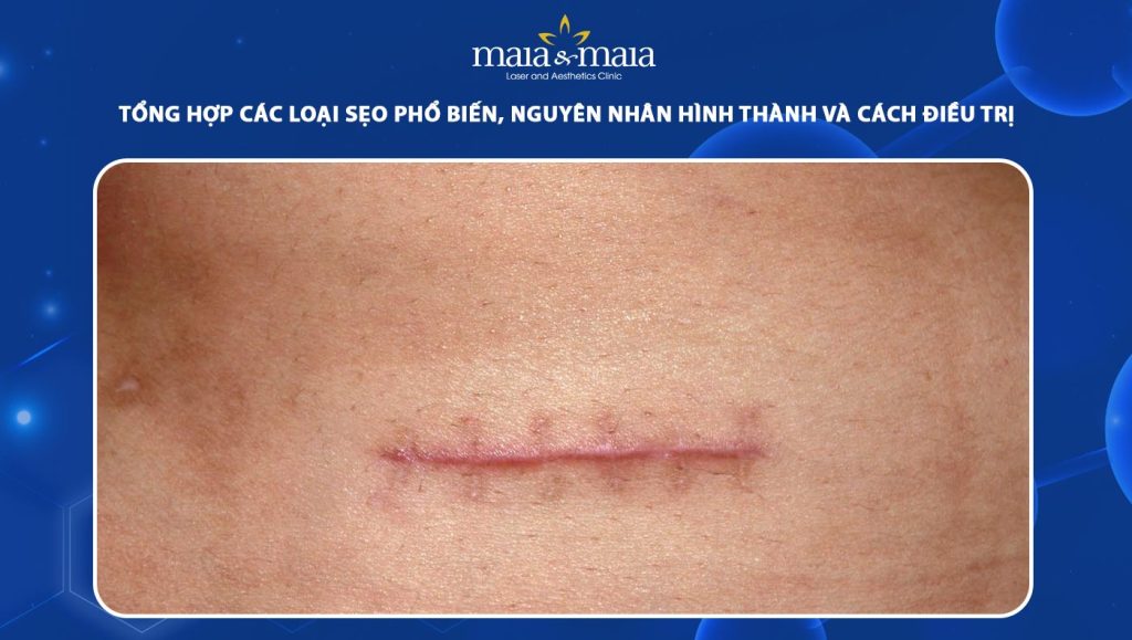 Tổng hợp các loại sẹo phổ biến, nguyên nhân hình thành và cách điều trị 1 các loại sẹo