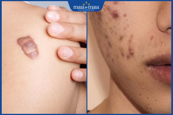Tổng hợp các loại sẹo phổ biến, nguyên nhân hình thành và cách điều trị 3 các loại sẹo khác nhau