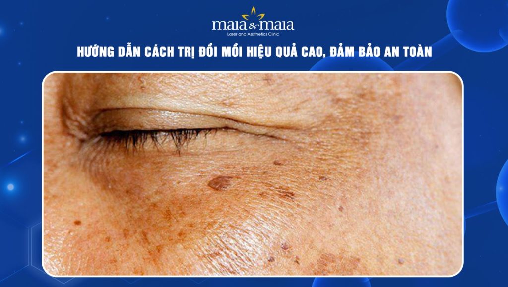Hướng dẫn cách trị đồi mồi hiệu quả cao, đảm bảo an toàn 1 cách trị đồi mồi