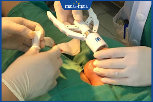 Nổi đốm trắng ở vùng kín nam là bệnh gì? Có nguy hiểm không? 4 cắt bỏ bao quy đầu