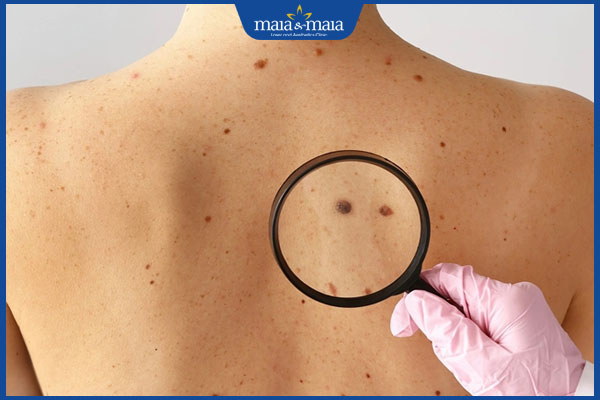 Đốm đen trên da: Nguyên nhân, chẩn đoán và cách cải thiện 3 chẩn đoán đốm đen