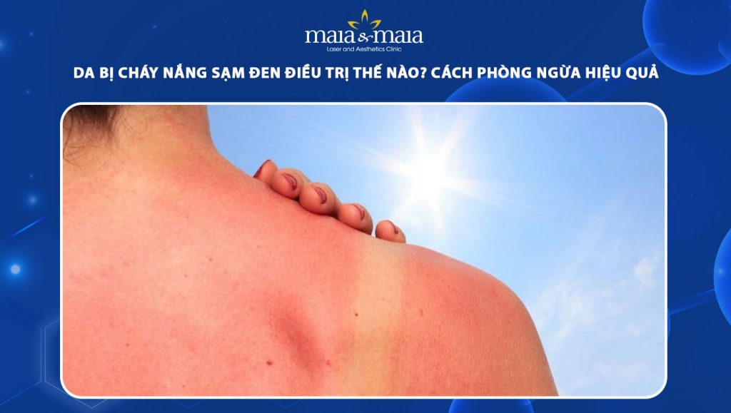 Da bị cháy nắng sạm đen điều trị thế nào? Cách phòng ngừa hiệu quả 1 da bị cháy nắng sạm đen