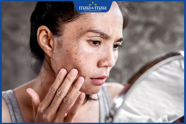 Đốm đồi mồi sau đi biển: Nguyên nhân và cách xử lý 2 da bị đồi mồi sau đi biển