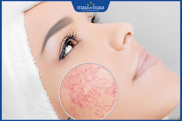 Tàn nhang đỏ: Nguyên nhân gây nên và cách khắc phục hiệu quả 3 da bị tổn thương mao mạch