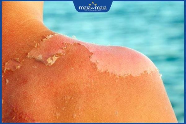 Da bị cháy nắng sạm đen điều trị thế nào? Cách phòng ngừa hiệu quả 2 da cháy nắng