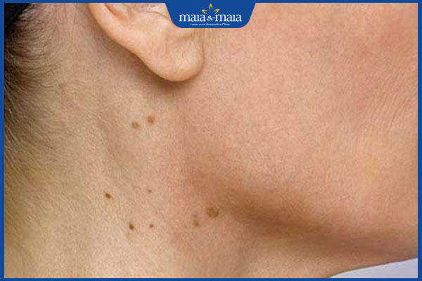 Đồi mồi ở cổ xuất hiện do đâu? Phương pháp điều trị hiệu quả 3 da cổ lão hoá tự nhiên