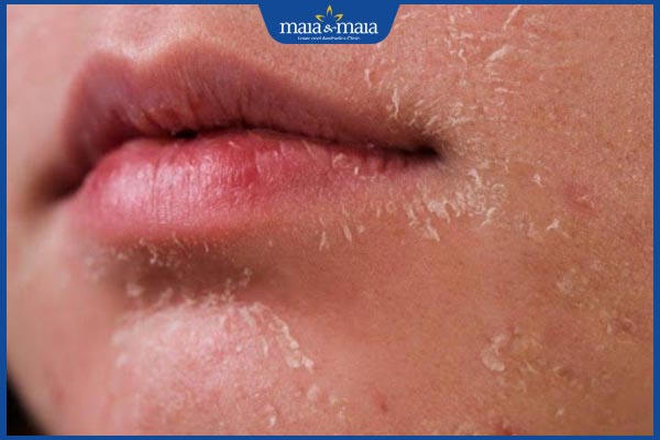 Sau khi đốt tàn nhang có nên rửa mặt không? Những lưu ý cần biết 4 da mặt bong tróc