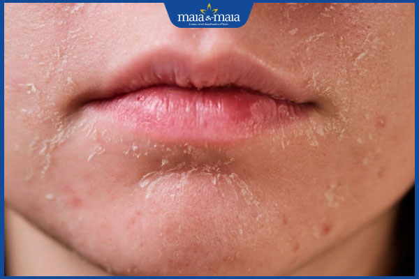 Đốm nâu trên mặt: Đặc điểm, nguyên nhân và cách điều trị 3 da mặt ngứa và bong tróc