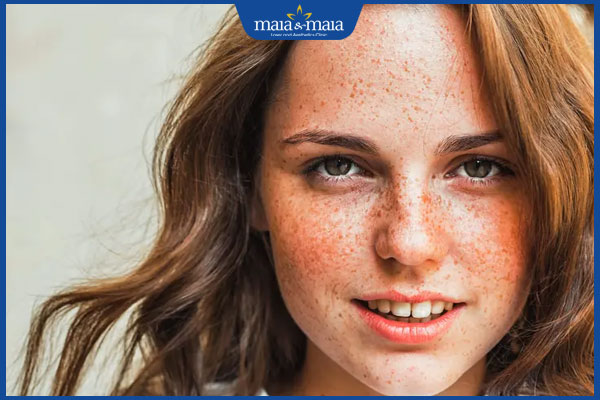 Nám, tàn nhang và đốm nâu có gì khác nhau? Phương pháp điều trị 2 da tàn nhang