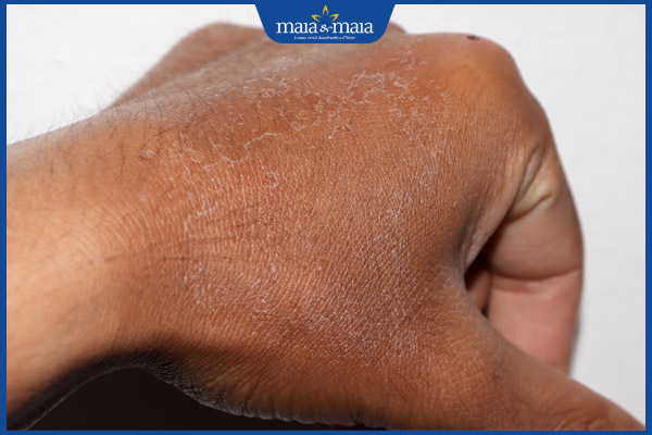 Cách cải thiện sạm da tay nhanh chóng và hiệu quả nhất 2 da tay sạm bong tróc