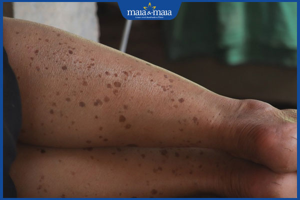 Bác sĩ giải đáp: Đồi mồi ở chân có xóa bỏ dứt điểm được không? 2 đặc điểm đồi mồi ở chân