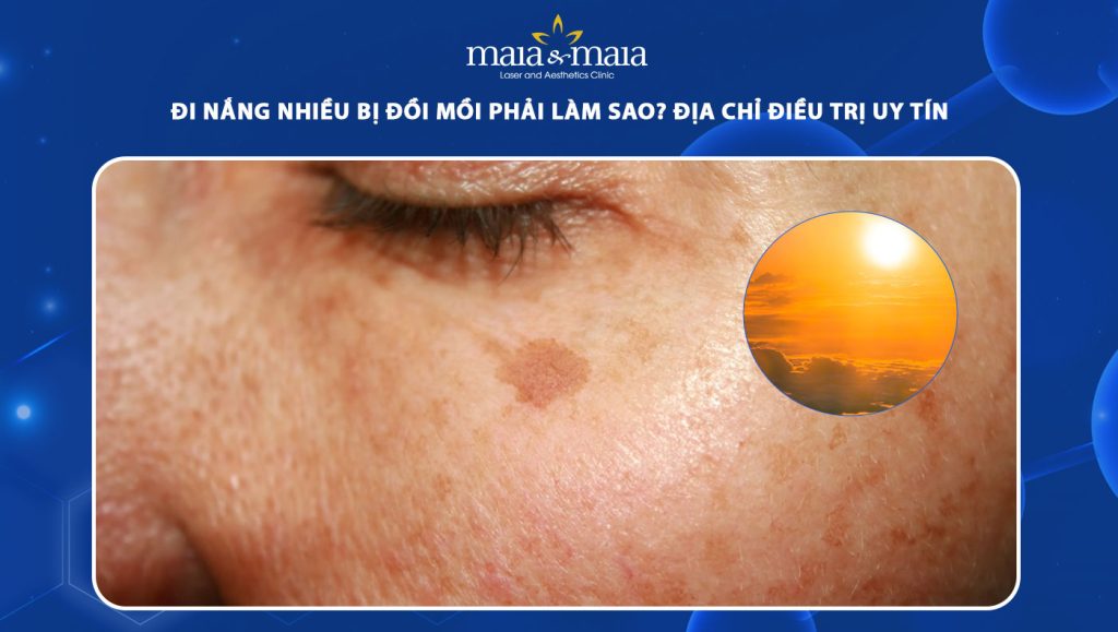 đi nắng nhiều bị đồi mồi