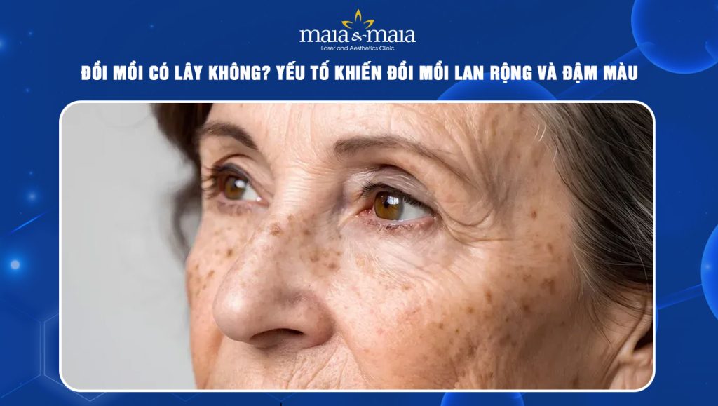 đồi mồi có lây không