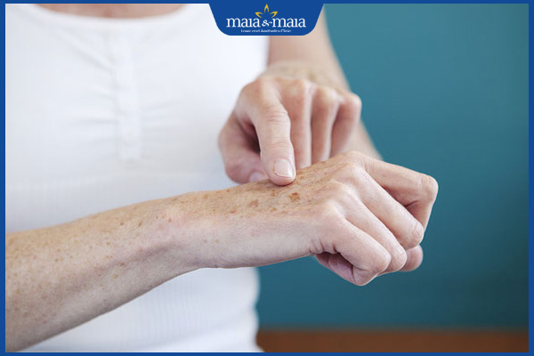 Đồi mồi có tự hết không? Gợi ý giải pháp làm mờ vết đồi mồi 2 đồi mồi không thể tự hết