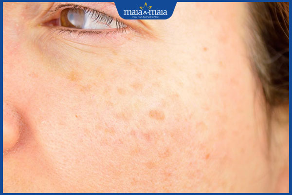 Gợi ý 6 kem trị đồi mồi, dưỡng sáng da được ưa chuộng hiện nay 7 đồi mồi nhạt màu số lượng ít