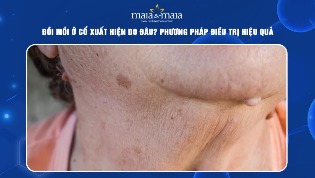 Đồi mồi ở cổ xuất hiện do đâu? Phương pháp điều trị hiệu quả 1 đồi mồi ở cổ