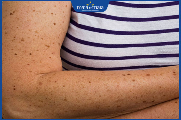 Đốm đen trên da: Nguyên nhân, chẩn đoán và cách cải thiện 2 đốm đen mọc riêng lẻ