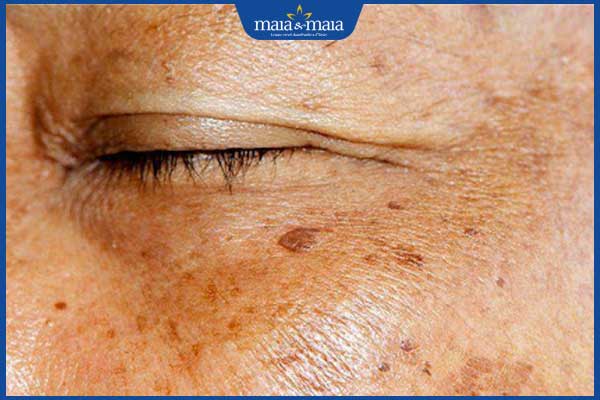 Đốm nâu trên mặt: Đặc điểm, nguyên nhân và cách điều trị 2 đốm đồi mồi trên mặt