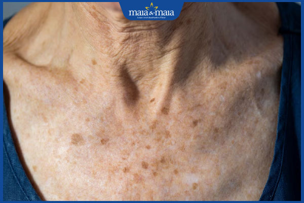 Đồi mồi ở cổ xuất hiện do đâu? Phương pháp điều trị hiệu quả 2 đốm nâu ở cổ