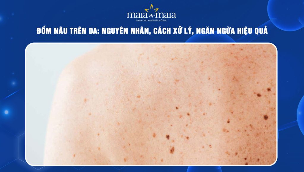 đốm nâu trên da