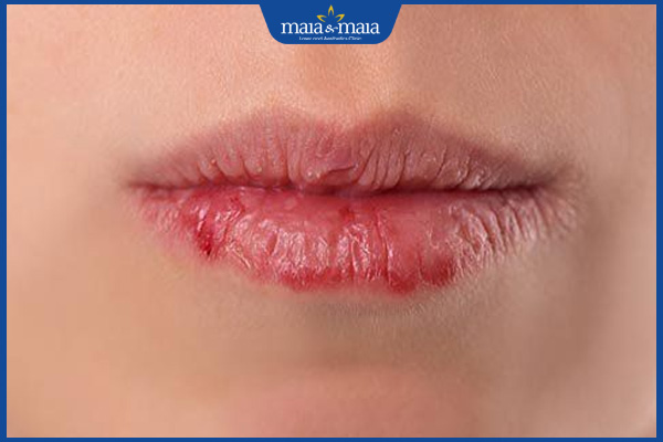 đốm trắng bị chảy máu